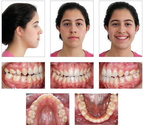 failed braces result|Unhappiness With Results of Orthodontics .